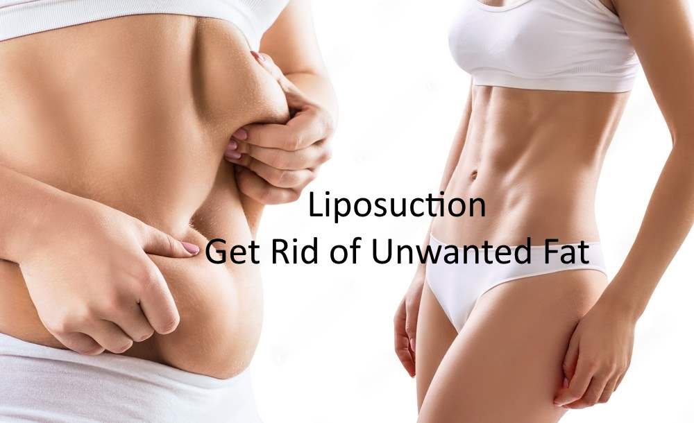 Liposuction: