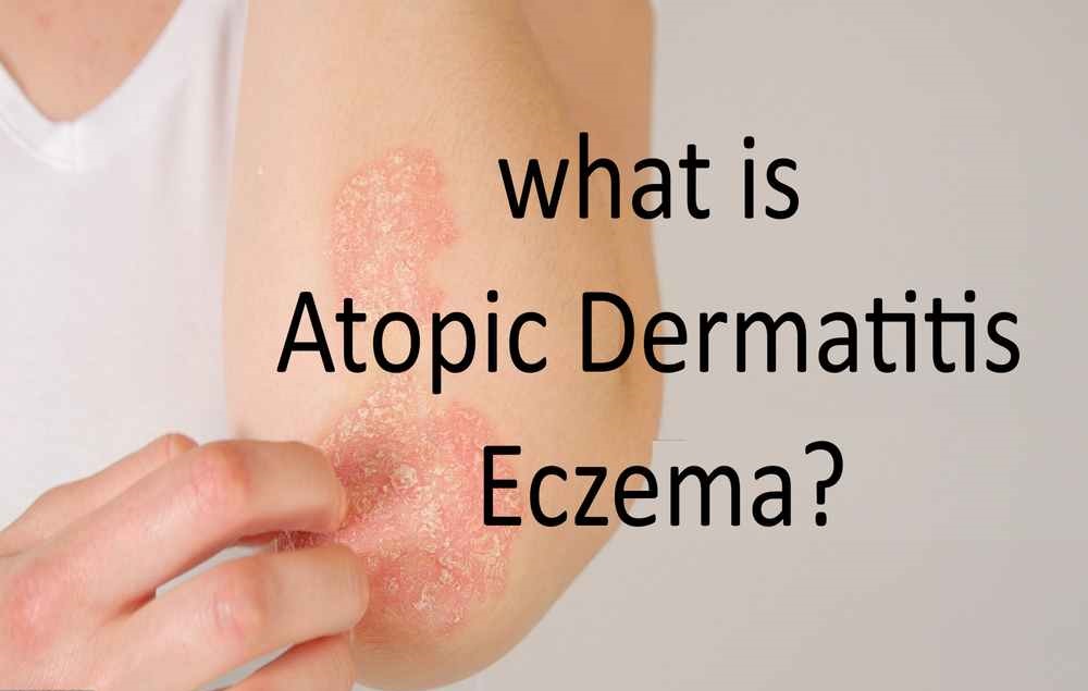 atopic dermatitis eczema