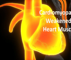 Cardiomyopathy: Weakened Heart Muscle