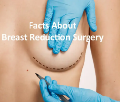 Facts About Breast Reduction Surgery
