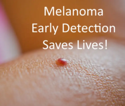 Melanoma: Early Detection Saves Lives!